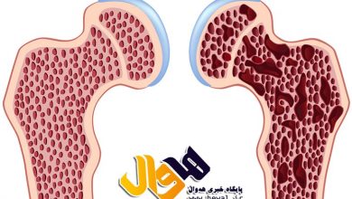 آهن,کمبود آهن,پوکی استخوان,استخئان های بدن,ویتامین ها,کم خونی