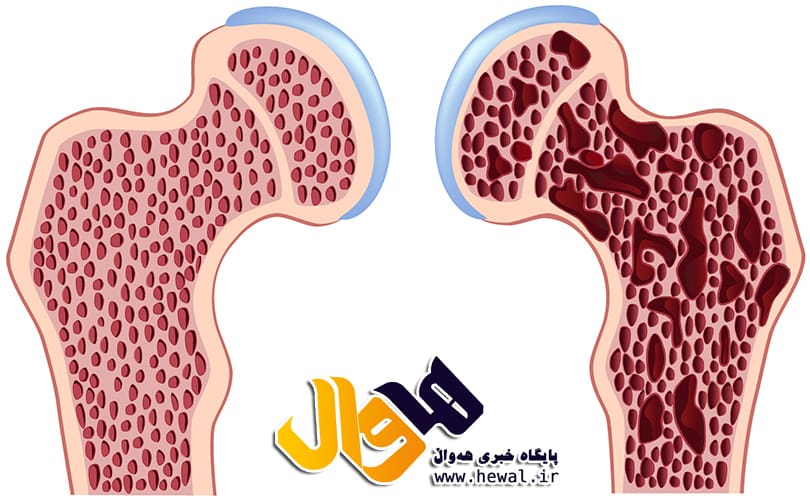 آهن,کمبود آهن,پوکی استخوان,استخئان های بدن,ویتامین ها,کم خونی
